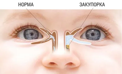 Отличия и симптомы конъюнктивита и дакриоцистита у грудничков -  энциклопедия Ochkov.net