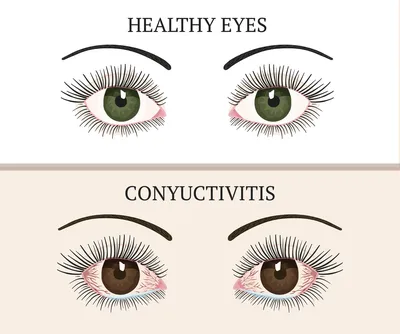 Конъюнктивит: формы заболевания, симптомы, лечение | Актипол®-М - здоровье  ваших глаз | Дзен