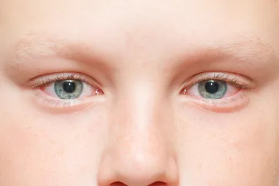 Красные глаза у ребенка | Детское Зрение | Дзен