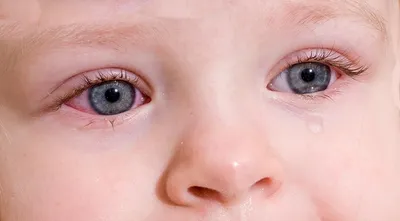 Глазные мази при лечении конъюнктивита у детей - энциклопедия Ochkov.net