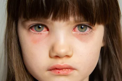Конъюнктивит у ребенка – причины, симптомы и лечение глаз в клинике «Будь  Здоров»