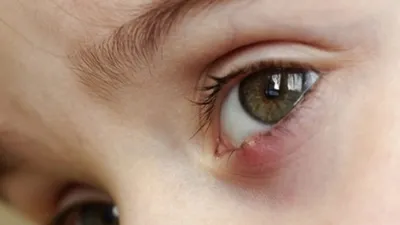 Закисают глаза у ребенка: причины и методы лечения - Офтальмологические  клиники «Эксимер» (Одесса) - диагностика и лечение заболеваний глаз у  взрослых и детей