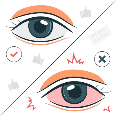 Клиника Кудрет Коз Бишкек - Конъюктивит – это воспалительное состояние  глаз, которое проявляется в виде покраснения конъюктивы, вызванное  аллергической реакцией или инфекцией. Выделяют два самых распространенных  вида конъюктивы: Аллергический и ...
