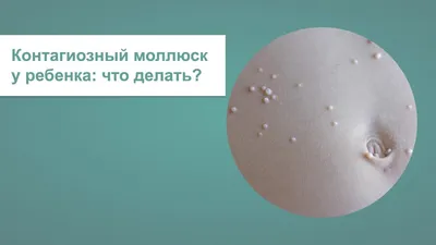 Контагиозный моллюск: как лечить? ⠀ ❓Что это? Контагиозный моллюск – это  кожное заболевание, которое вызывает вирус. Он из той же семьи… | Instagram