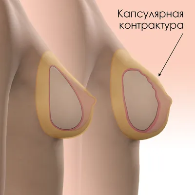 Контрактура грудного импланта фото фото