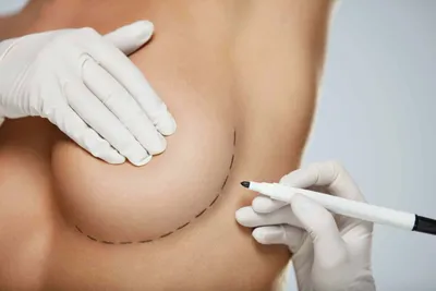 Удаление грудных имплантов - цена на реэндопротезирование имплантов груди в  СПб