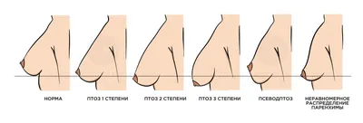 Капсулярная контрактура после реконструкции молочной железы - история  лечения в Ильинской больнице.
