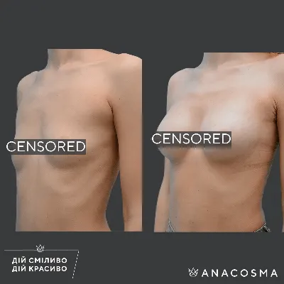 Виды имплантов для увеличения груди: формы, поверхность, размеры