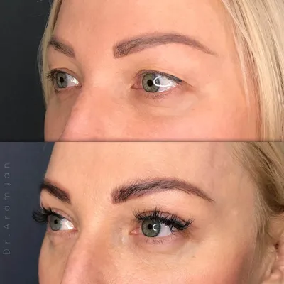 Подтяжка бровей / Brow lift в Москве в Damas Medical Center