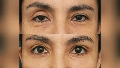 Контурная пластика глаз в СПб: цены на инъекции филлеров вокруг глаз в  клинике Груздева