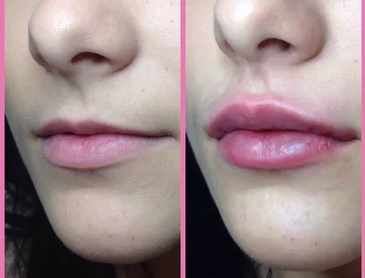 Фото \"до и после\" контурной пластики губ: примеры работ коррекции губ  филлерами врачей клиники косметологии Груздева
