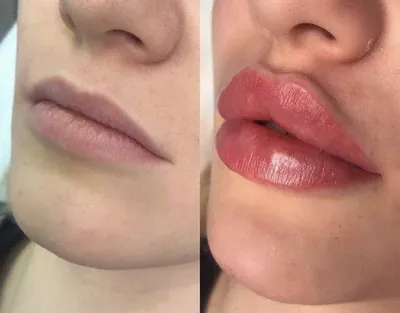 Контурная пластика губ препаратом Art Filler Lips