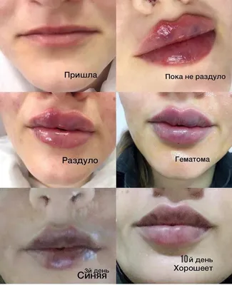 До/после 😍 Контурная пластика губ по авторской методике @elcosmo_clinic 👄  ✔️ Скорректировали асимметрию ✔️ Добавили объем ✔️ Увлажнили… | Instagram