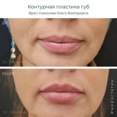 Увеличение губ с помощью контурной пластики
