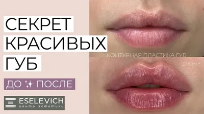 Увеличение и бьютификация губ. До и После (Фото)