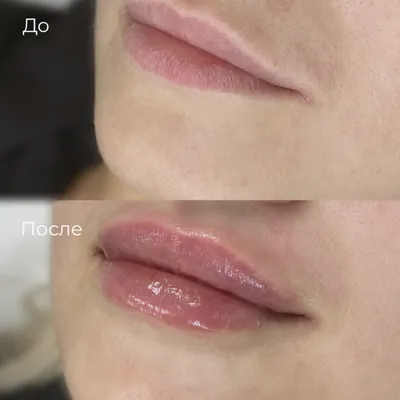 Контурная пластика губ (работы до и после): фото медцентра Оксфорд Медикал  Кривой Рог