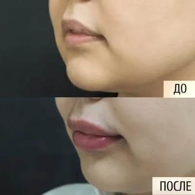 Увеличение губ гиалуроновой кислотой: фото до и после, отзывы специалистов,  как проходит процедура