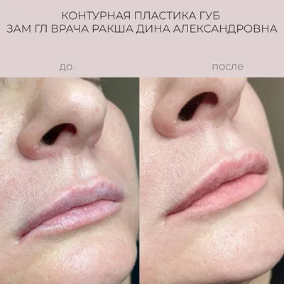 Фото \"до и после\" контурной пластики губ: примеры работ коррекции губ  филлерами врачей клиники косметологии Груздева