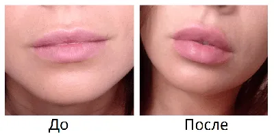 Dr.Nepushenkova Kristina - 👄Контурная пластика губ👄 Работа с  обучения(самостоятельная 😉) Очень довольна результатом💕Сделали небольшую  докоррекцию(уже не я). Как Вам результат?💕 ◾️Контурная пластика губ  ◾️Врач-Непушенкова Кристина ◾️На фото ...