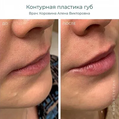 До/после :контурная пластика губ👄 ⠀ #контурнаяпластикагуб #губы  #аугментациягуб #филлер #косметологияиркутск #косметолог #увеличениегуб… |  Instagram