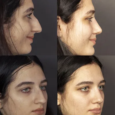 Фото до и после — Пластика носа (ринопластика) — клиника Seline
