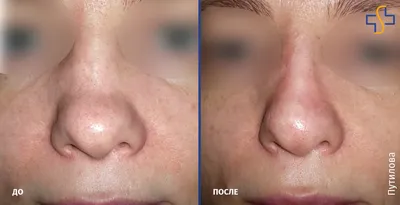 Контурная пластика носа с помощью филлера - YouTube