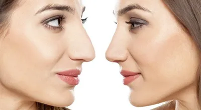 Контурная пластика носа | Доктор Марина Гогина