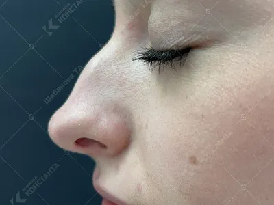 Контурная пластика носа - gorgeous