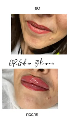 Увеличение и бьютификация губ. До и После (Фото)