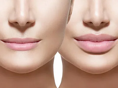 💋 Увеличение губ в Люберцах и Некрасовке. Аугментация губ: липофилинг,  контурная пластика
