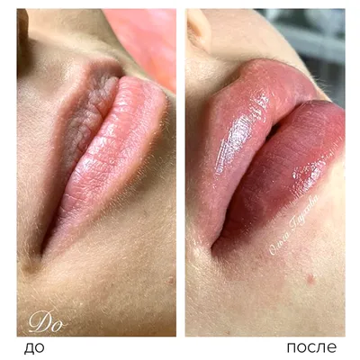 Увеличение губ – это красиво, но важно помнить о мере! | PROFFLESSON | Дзен
