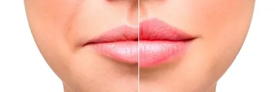 Контурная пластика губ. Увеличение губ. Збільшення губ. - Модели для  бьюти-услуг Одесса на Olx