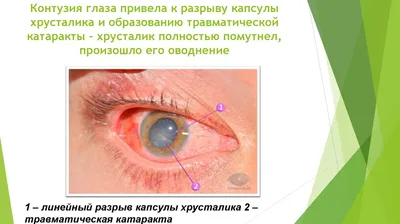 Травмы глаза - презентация онлайн