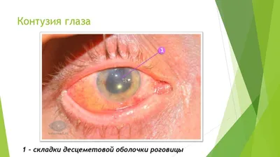 Травматическая атрофия зрительного нерва - причины, симптомы, диагностика,  лечение и профилактика