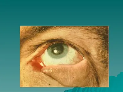 Сложные случаи хирургии катаракты Доклад Тешев Адам