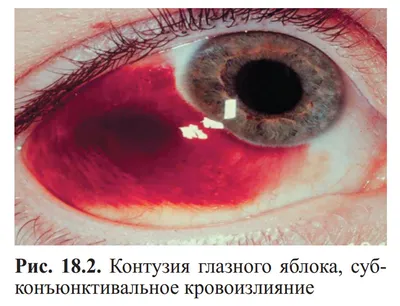 Рис. 18.2. Контузия глазного яблока, субконъюнктивальное кровоизлияние…