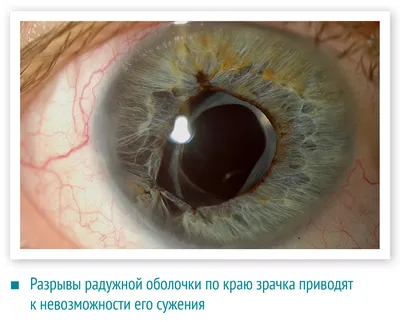 Травма глаза. Первая помощь и дальнейшее лечение травмы глаза