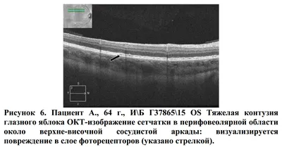 Лечение макулярной патологии - Центр офтальмологии ФГБУ «Национальный  медико-хирургический Центр им. Н.И. Пирогова»