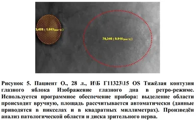 Клинические рекомендации Травма глаза закрытая | Библиотека по офтальмологии