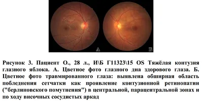 Рис. 18.3. Контузия глазного яблока, гифема