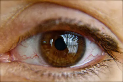 Грыжи стекловидного тела глаза: причины, симптомы и лечение