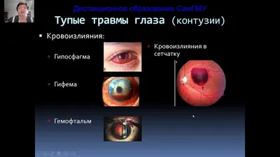 Рис. 131. Флюоресцентная ангулограмма больного Ж., 32 лет. Артерио-вен…