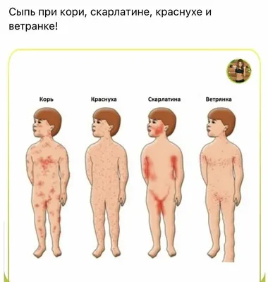 Корь у детей — что это, симптомы, диагностика и лечение болезни