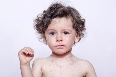 При кори симптомы у детей возникают внезапно. Инкубационный период  составляет от 9 до 12 суток. У детей, прошедших иммунизацию до 21 суток.… |  Instagram