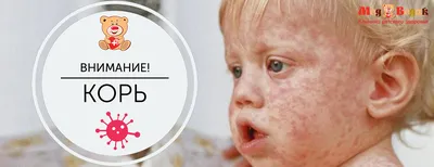 Вспышка кори в Харькове: как распознать симптомы - YouTube