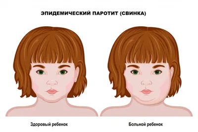 Корь: симптомы у детей и возможные осложнения от вируса - Газета.Ru