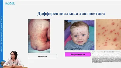 Комаровский: корь, краснуха, розеола | ➕ Скорая помощь Online | ВКонтакте