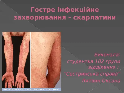 Cкарлатин — Детская городская клиническая инфекционная больница Алматы