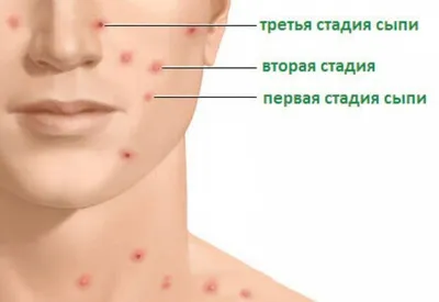 На Сааремаа корью заболели еще два взрослых человека | Эстония | ERR