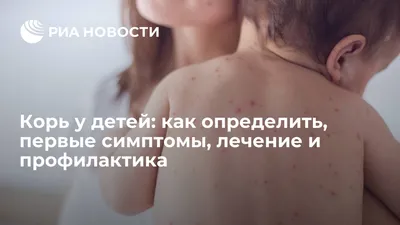 Корь | симптомы и причины кори у детей и взрослых, диагностика, лечение и  профилактика